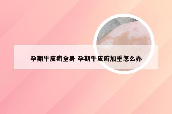 孕期牛皮癣全身 孕期牛皮癣加重怎么办