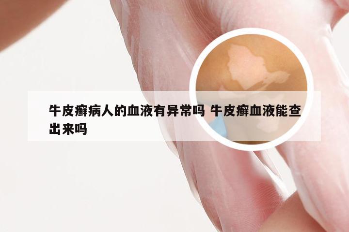 牛皮癣病人的血液有异常吗 牛皮癣血液能查出来吗