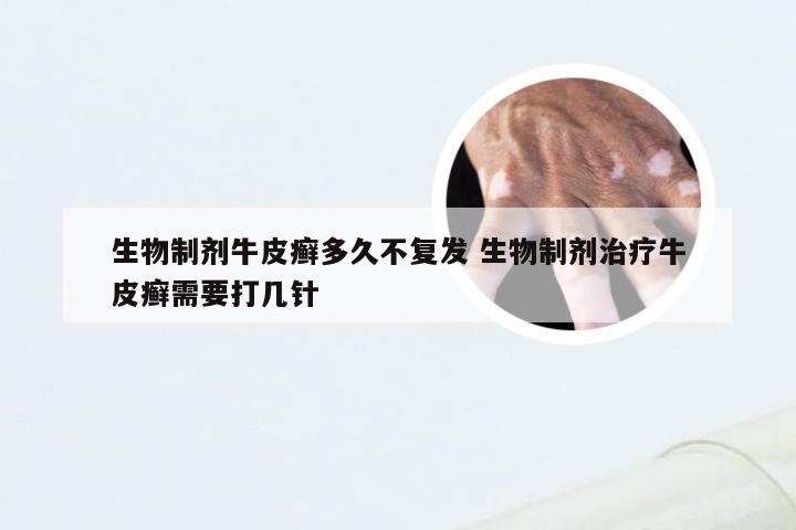 生物制剂牛皮癣多久不复发 生物制剂治疗牛皮癣需要打几针
