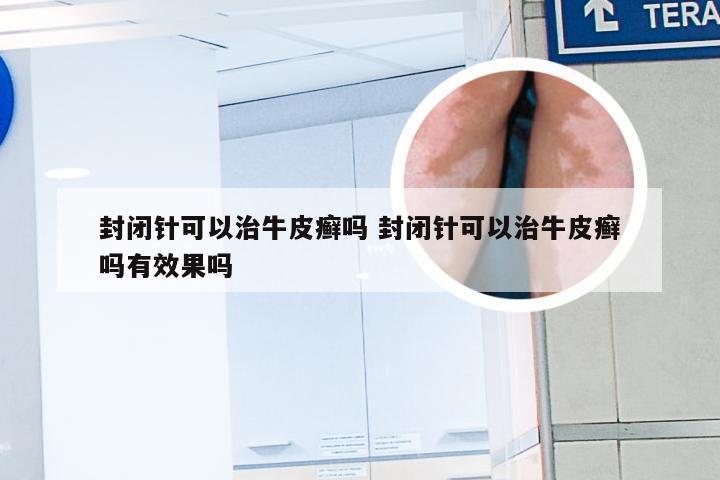 封闭针可以治牛皮癣吗 封闭针可以治牛皮癣吗有效果吗