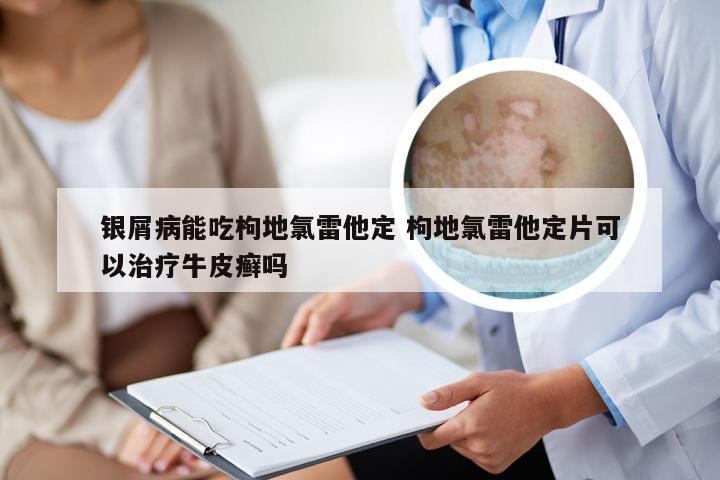 银屑病能吃枸地氯雷他定 枸地氯雷他定片可以治疗牛皮癣吗