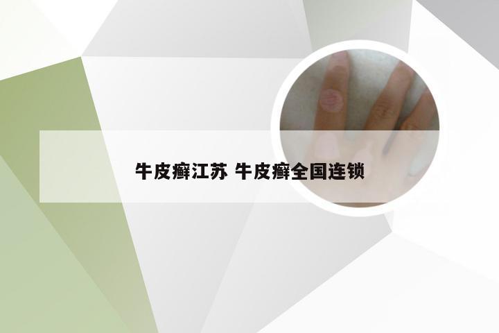 牛皮癣江苏 牛皮癣全国连锁