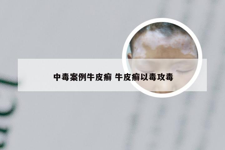 中毒案例牛皮癣 牛皮癣以毒攻毒