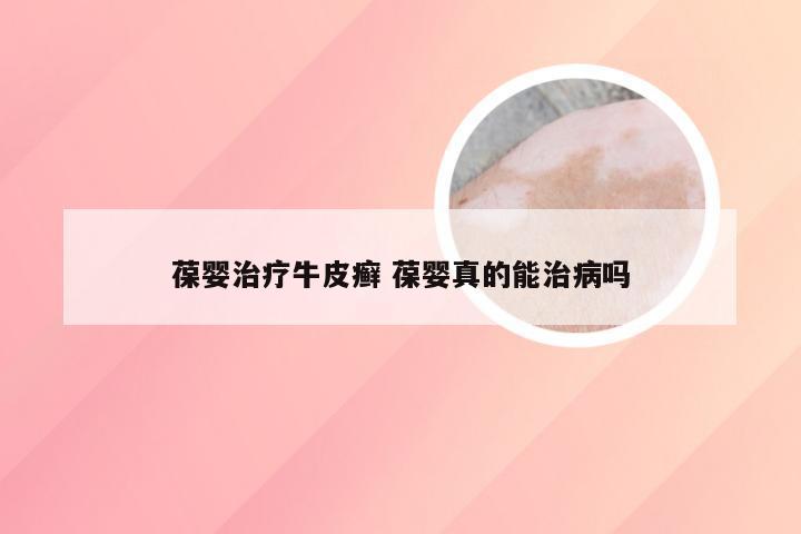 葆婴治疗牛皮癣 葆婴真的能治病吗