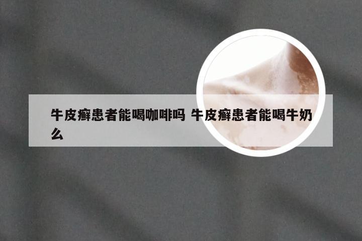 牛皮癣患者能喝咖啡吗 牛皮癣患者能喝牛奶么