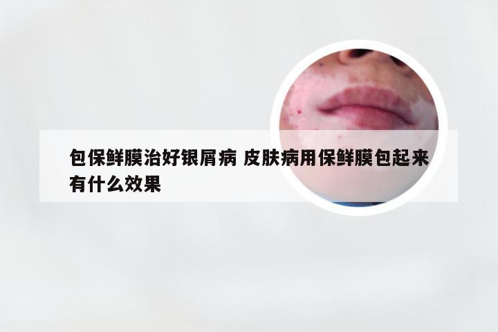 包保鲜膜治好银屑病 皮肤病用保鲜膜包起来有什么效果