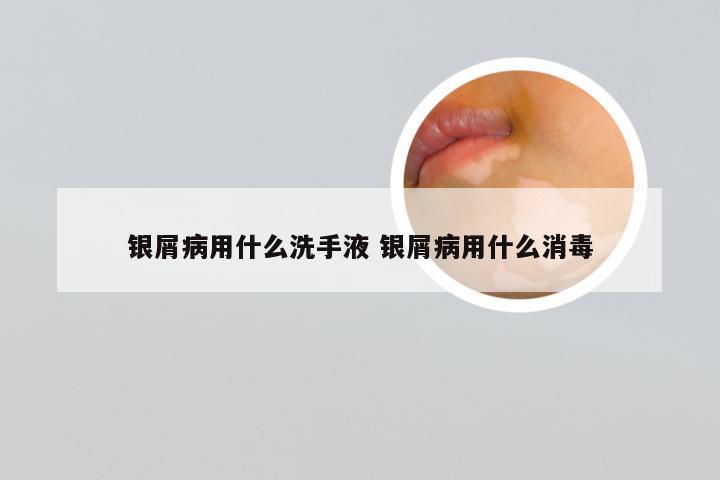 银屑病用什么洗手液 银屑病用什么消毒