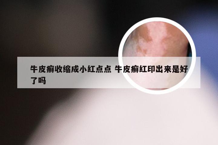 牛皮癣收缩成小红点点 牛皮癣红印出来是好了吗