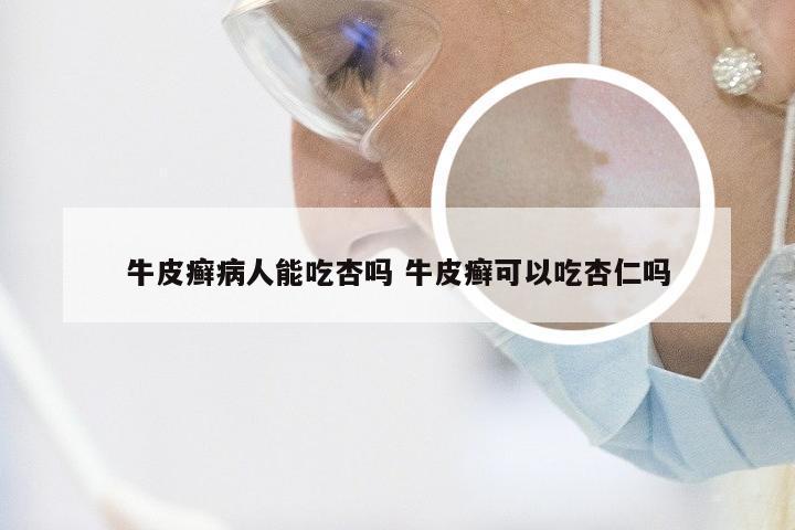 牛皮癣病人能吃杏吗 牛皮癣可以吃杏仁吗