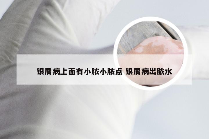 银屑病上面有小脓小脓点 银屑病出脓水
