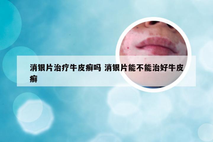 消银片治疗牛皮癣吗 消银片能不能治好牛皮癣