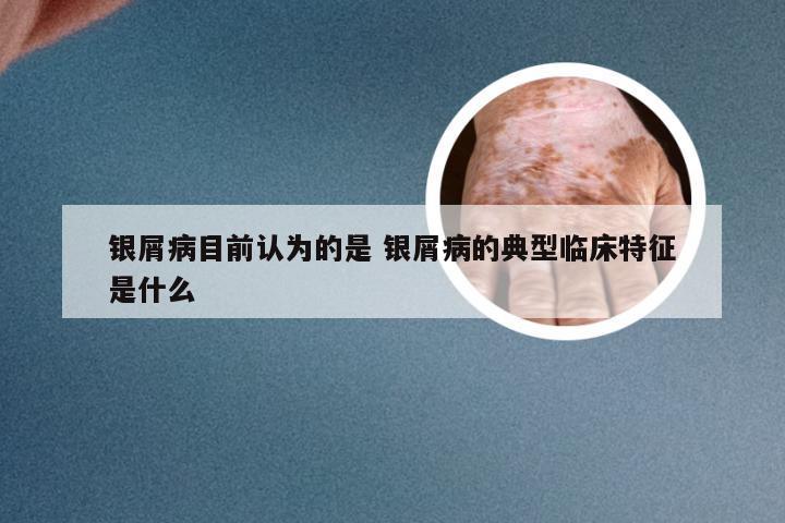 银屑病目前认为的是 银屑病的典型临床特征是什么