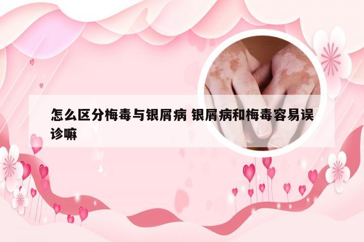 怎么区分梅毒与银屑病 银屑病和梅毒容易误诊嘛