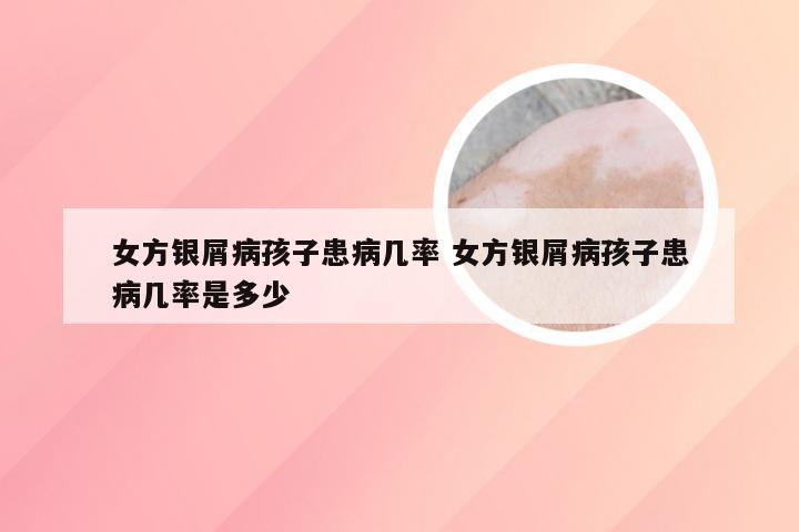 女方银屑病孩子患病几率 女方银屑病孩子患病几率是多少