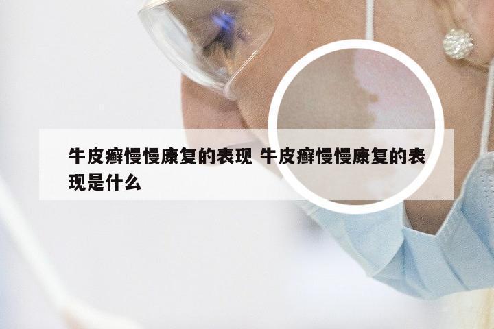 牛皮癣慢慢康复的表现 牛皮癣慢慢康复的表现是什么