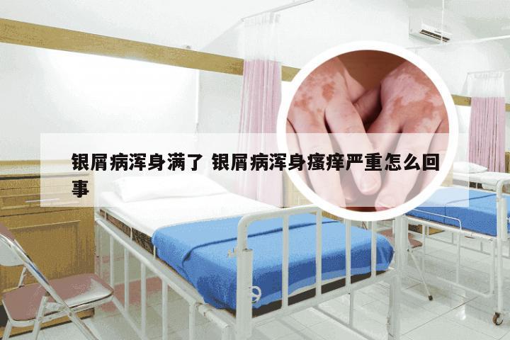 银屑病浑身满了 银屑病浑身瘙痒严重怎么回事