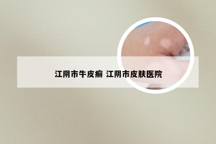 江阴市牛皮癣 江阴市皮肤医院