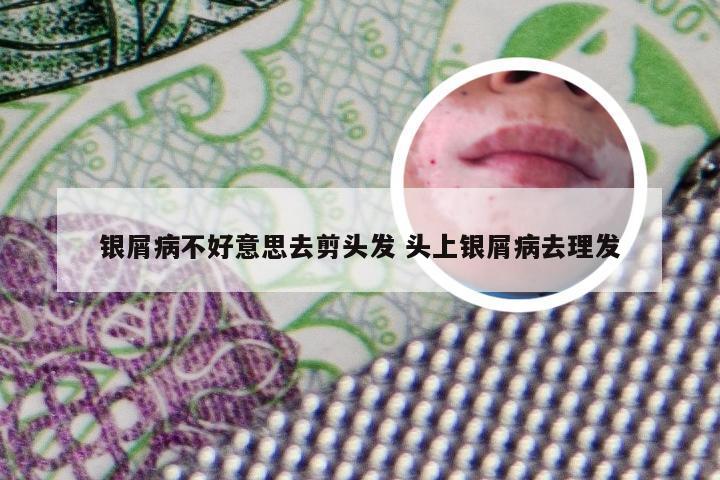 银屑病不好意思去剪头发 头上银屑病去理发