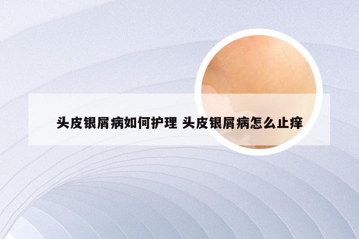 头皮银屑病如何护理 头皮银屑病怎么止痒