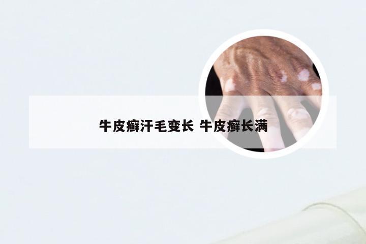 牛皮癣汗毛变长 牛皮癣长满