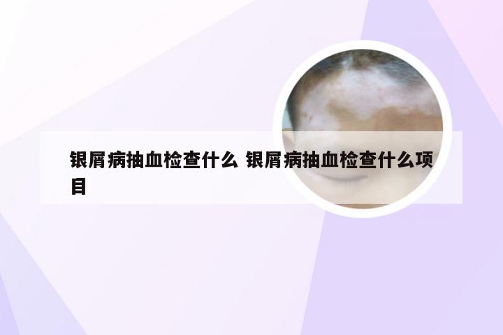 银屑病抽血检查什么 银屑病抽血检查什么项目
