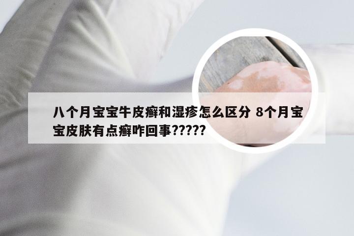 八个月宝宝牛皮癣和湿疹怎么区分 8个月宝宝皮肤有点癣咋回事?????