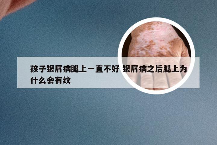 孩子银屑病腿上一直不好 银屑病之后腿上为什么会有纹