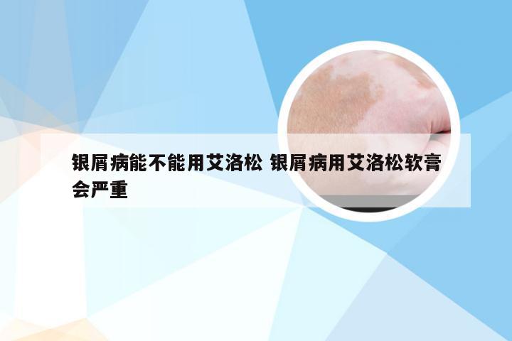 银屑病能不能用艾洛松 银屑病用艾洛松软膏会严重