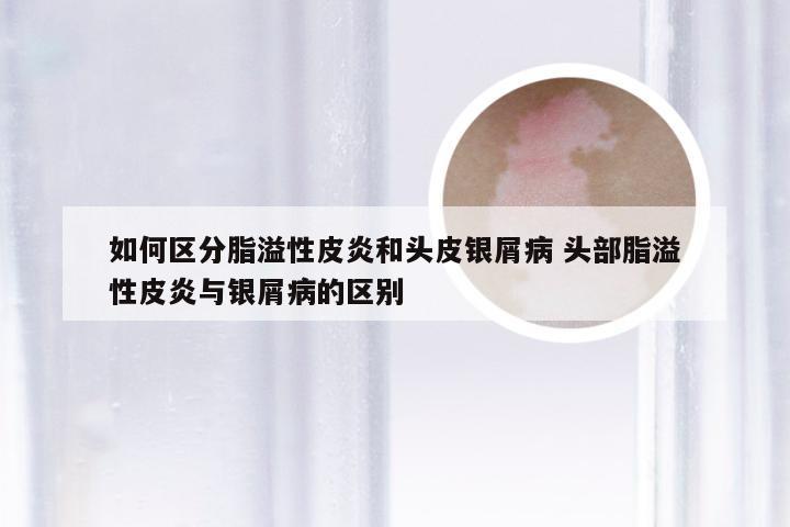 如何区分脂溢性皮炎和头皮银屑病 头部脂溢性皮炎与银屑病的区别