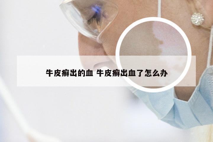 牛皮癣出的血 牛皮癣出血了怎么办