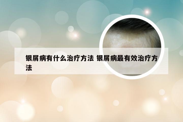 银屑病有什么治疗方法 银屑病最有效治疗方法