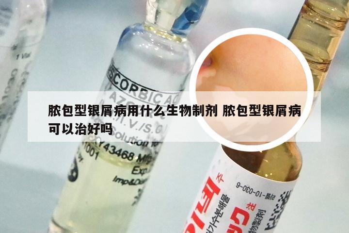脓包型银屑病用什么生物制剂 脓包型银屑病可以治好吗
