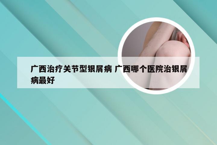 广西治疗关节型银屑病 广西哪个医院治银屑病最好