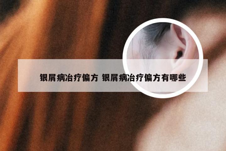 银屑病冶疗偏方 银屑病冶疗偏方有哪些