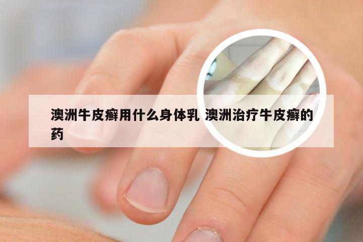 澳洲牛皮癣用什么身体乳 澳洲治疗牛皮癣的药
