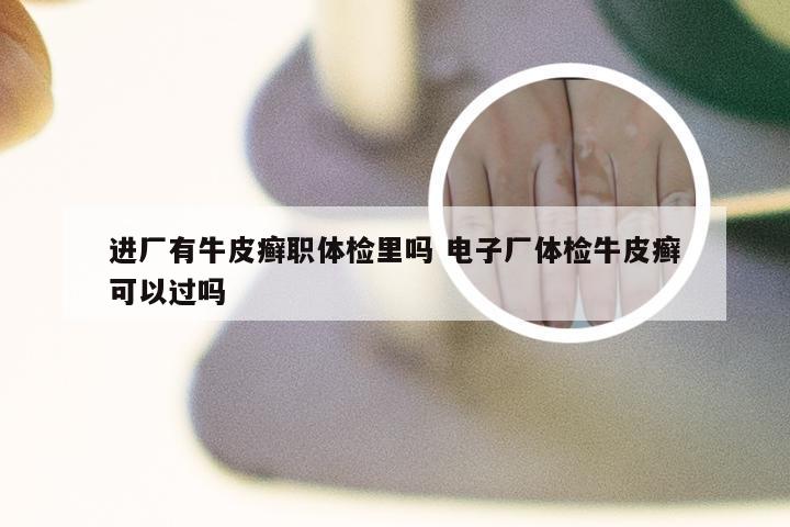 进厂有牛皮癣职体检里吗 电子厂体检牛皮癣可以过吗