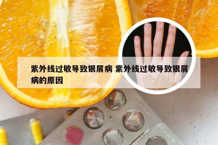 紫外线过敏导致银屑病 紫外线过敏导致银屑病的原因