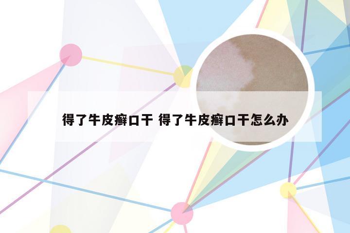 得了牛皮癣口干 得了牛皮癣口干怎么办