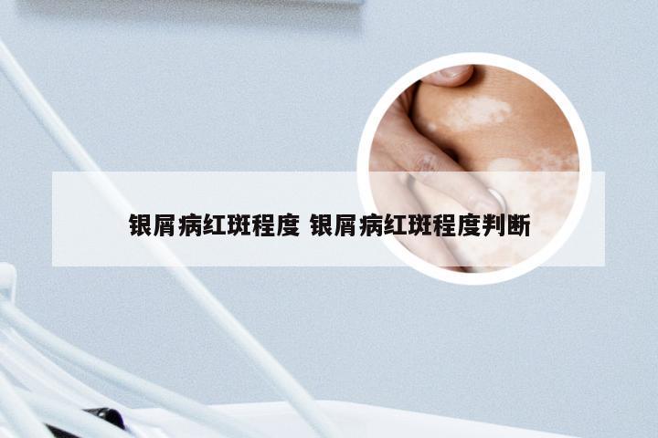 银屑病红斑程度 银屑病红斑程度判断