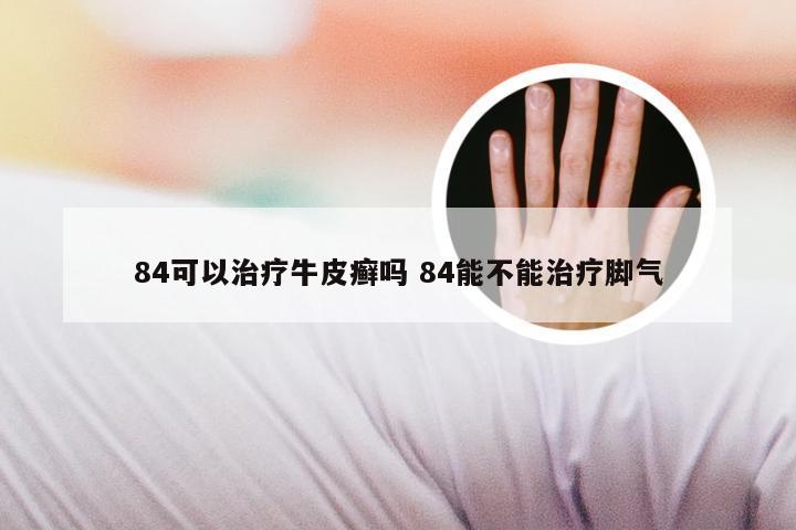 84可以治疗牛皮癣吗 84能不能治疗脚气