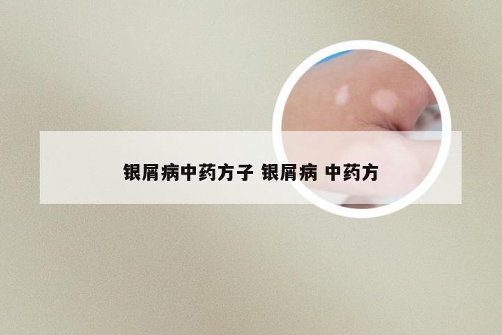 银屑病中药方子 银屑病 中药方
