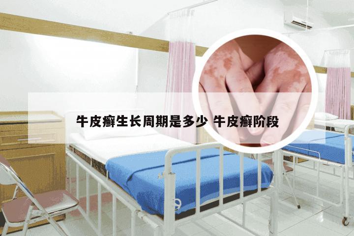牛皮癣生长周期是多少 牛皮癣阶段
