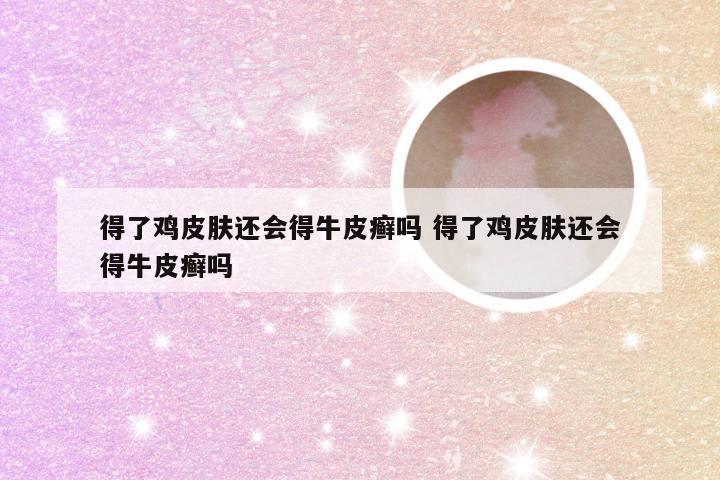 得了鸡皮肤还会得牛皮癣吗 得了鸡皮肤还会得牛皮癣吗