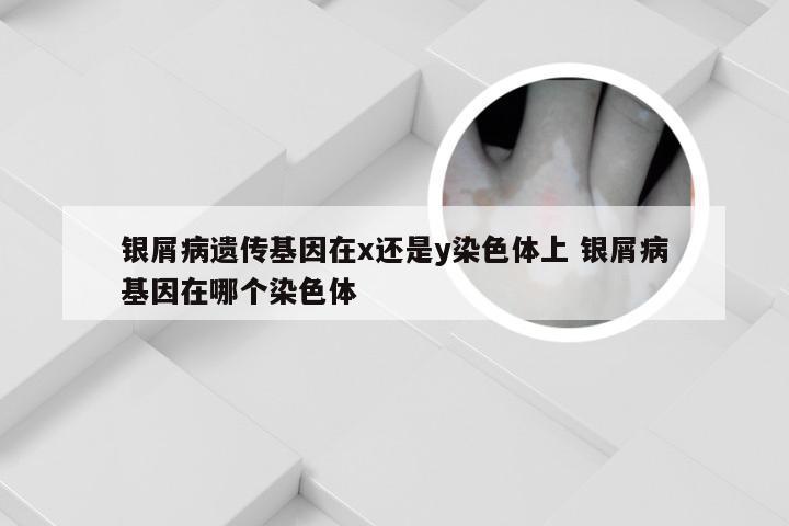 银屑病遗传基因在x还是y染色体上 银屑病基因在哪个染色体
