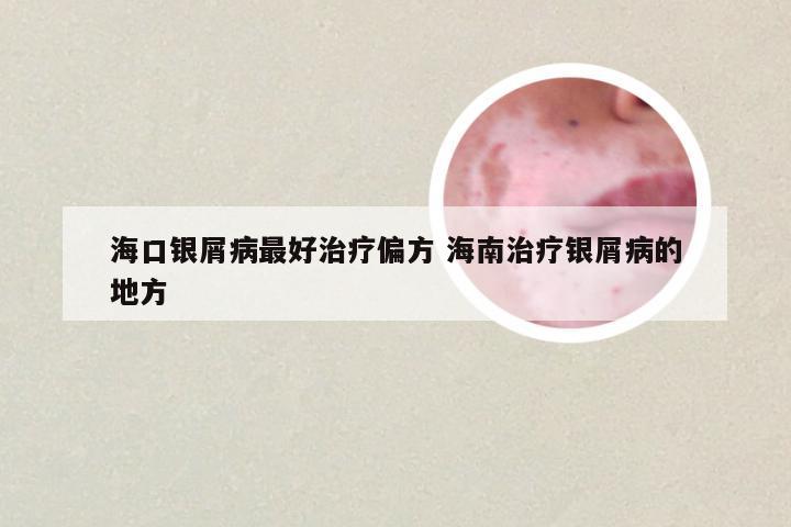 海口银屑病最好治疗偏方 海南治疗银屑病的地方