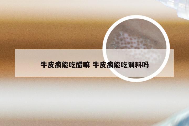 牛皮癣能吃醋嘛 牛皮癣能吃调料吗