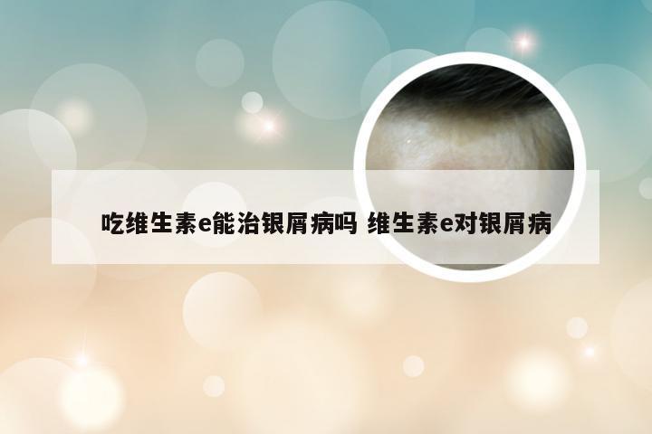吃维生素e能治银屑病吗 维生素e对银屑病
