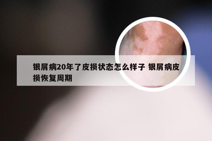 银屑病20年了皮损状态怎么样子 银屑病皮损恢复周期