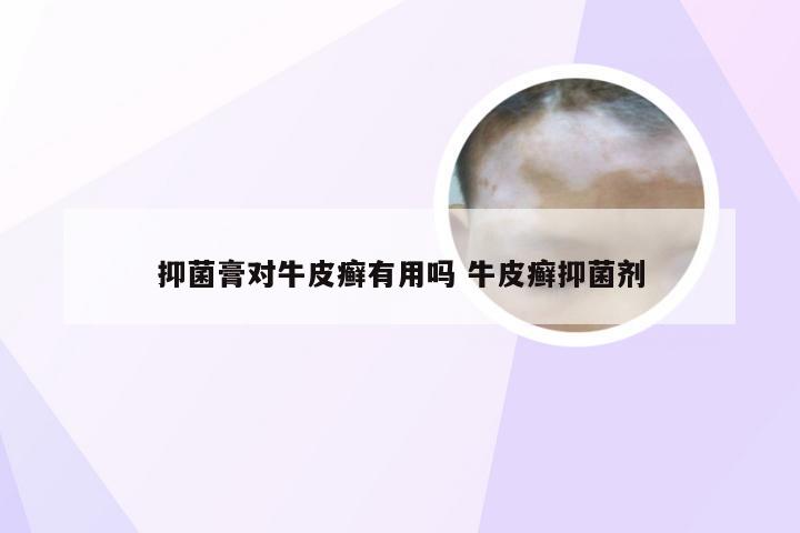 抑菌膏对牛皮癣有用吗 牛皮癣抑菌剂