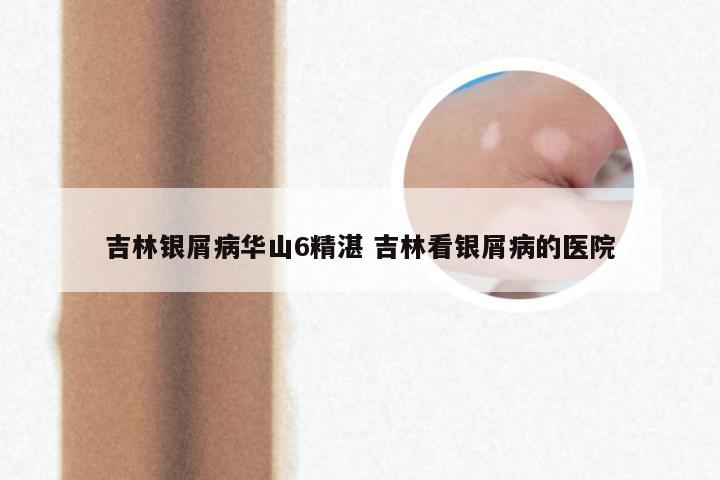吉林银屑病华山6精湛 吉林看银屑病的医院